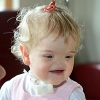 Bé gái sinh ra với dị tật không mũi cực kỳ hiếm gặp