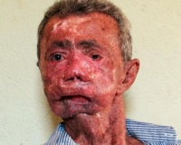 Bệnh lạ khiến cơ thể người thối rữa dưới nắng ở Brazil - ghê quá các bác ạ