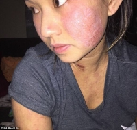 Cô gái gốc Việt bị lở loét toàn thân sau khi độn ngực