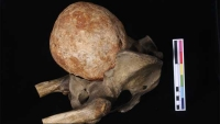 [MacproDS] Tử cung hóa đá 200 tuổi nặng 3kg ở Anh